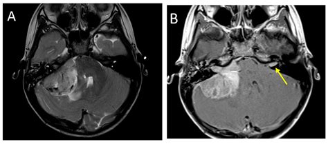 Diagnostics | Free Full-Text | MR Imaging of Pediatric Brain Tumors