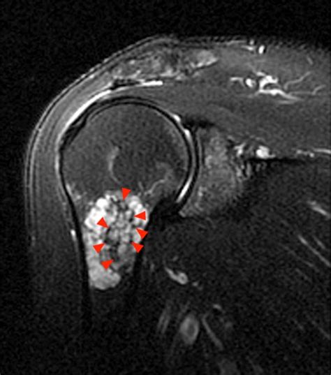 Chondroid Lesions | Radsource