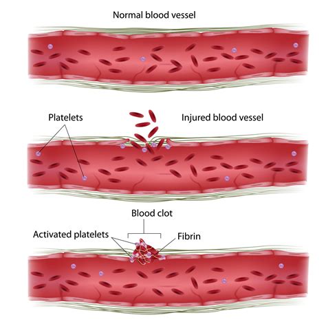 What is Thrombosis? | General information