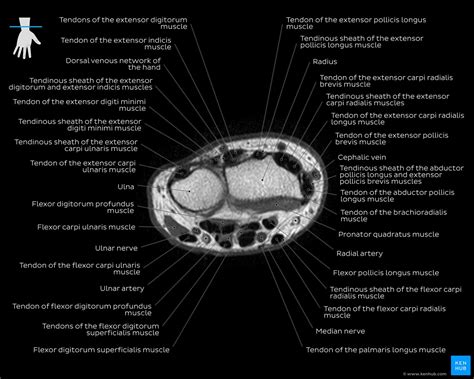 Extensor Pollicis Longus Mri