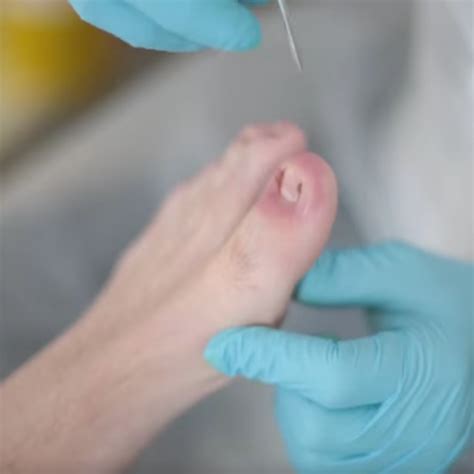 Ingrown Toenail Surgery & Removal Kent | The Foot Clinic