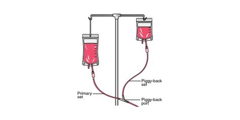 Intermittent Infusion Device Insertion - RNpedia