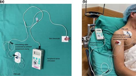 Peripheral Nerve Stimulation Through A 'dry' Peripheral, 59% OFF