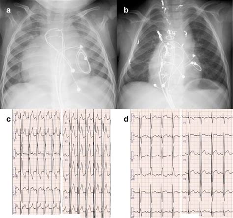 Adverse impact of univentricular pacing - Congenital Heart ...