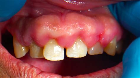 protáhnout se prezentace Kompatibilní s my gums are swollen Dobyvatel ...