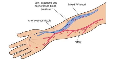 Arteriovenous (AV) Fistula Surgery - AV Fistula Surgery