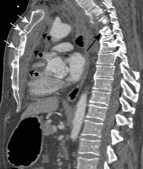 Sternal fracture. Sagittal reconstructed CT image shows multiple ...