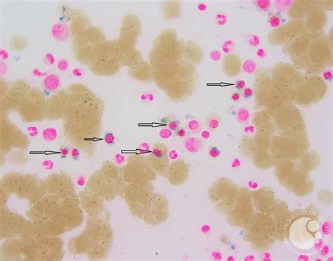 Iron stain showing multiple ring sideroblasts (black arrows) seen on 100x