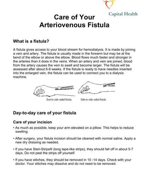 Care of Your Arteriovenous Fistula What is a fistula?