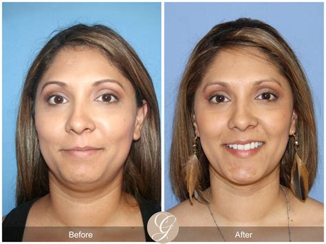 Neck Liposuction, Chin Augmentation 27 Before After Photos Orange County