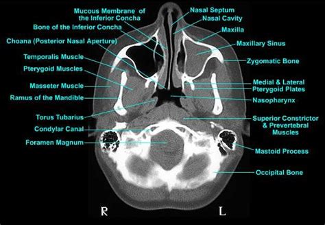 Medical radiology imaging tips blog: Torus tubarius ct scan anatomy