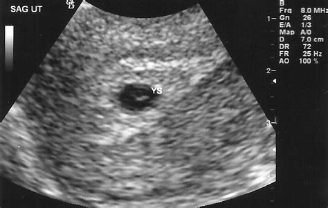 5 Week Ultrasound Pictures What Should An Ultrasound Show At 5 Weeks ...