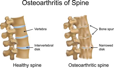 Spondylosis – Arc of Life