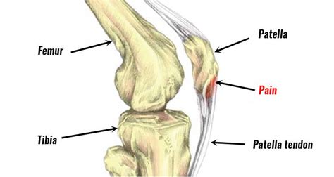 Patellar Tendinopathy: Jump Out Of Jumper’s Knee! – Physio Performance