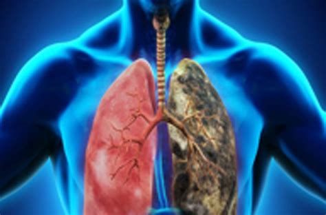 Lower Respiratory Tract Disease (Lung Disease)