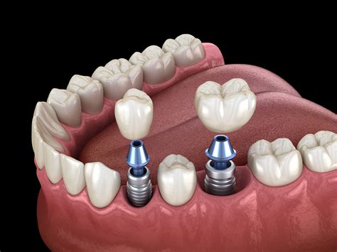 What Are Dental Implants Made Of? - Creekview Dental