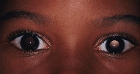 Facts about Amblyopia or Lazy Eye in Kids and its Treatment