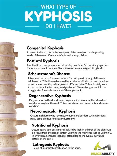 Postural Kyphosis