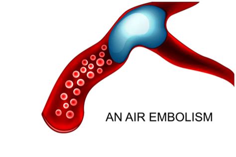 Air Embolism Symptoms Pregnancy - pregnancysymptoms