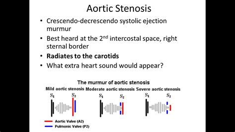 Aortic Stenosis Murmur