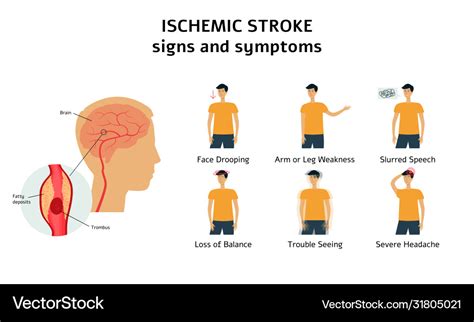 Ischemic stroke signs and symptoms infographic Vector Image