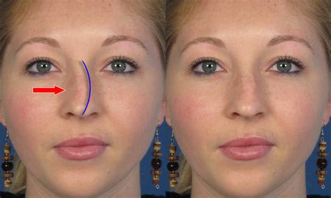 Crooked Nose Before And After Rhinoplasty Nose Surgery Photos | 2018 ...