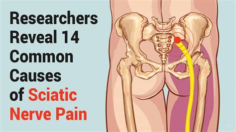 Researchers Reveal 14 Common Causes of Sciatic Nerve Pain