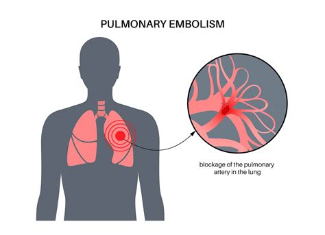 3 Symptoms of Pulmonary Embolism - Kingwood Emergency Hospital