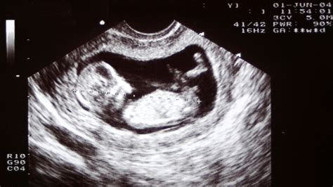 How To Get The Best Ultrasound Picture At 12 Weeks - PictureMeta