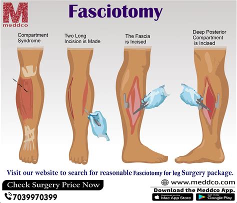 A guide through Fasciotomy Surgery