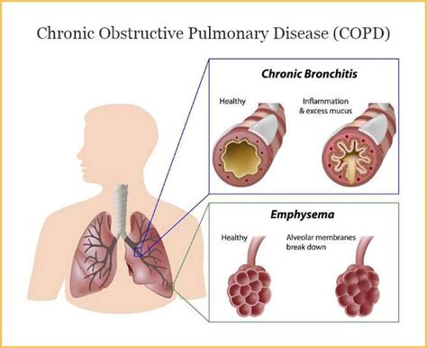 Chronic Obstructive Pulmonary Disease (COPD) | HALO Precision Diagnostics