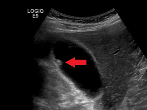 Gallbladder Polyps Ultrasound