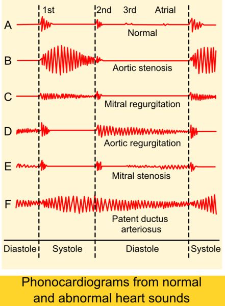 Diastolic heart murmur - wikidoc