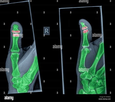 X-ray of a thumb with a broken distal phalanx Stock Photo - Alamy