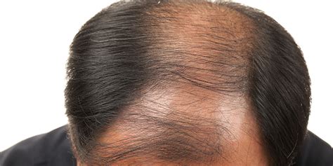 Male Pattern Baldness: Causes, Symptoms And Treatments