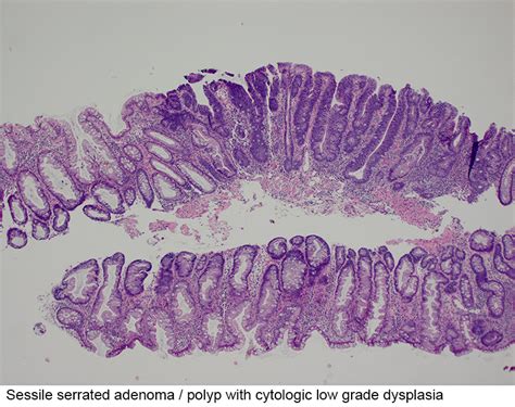 Pathology Outlines - Sessile serrated adenoma