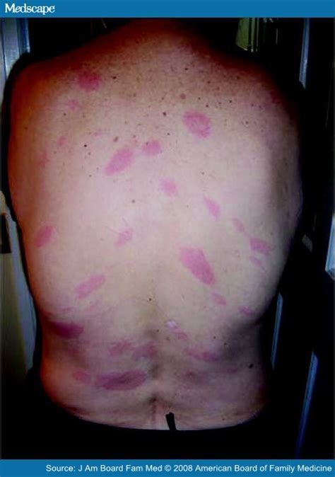 babesiosis rash - pictures, photos