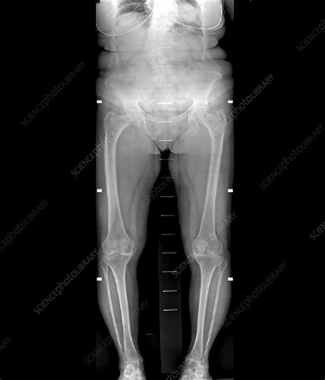 Bilateral knee osteoarthritis, X-ray - Stock Image - C046/9120 ...