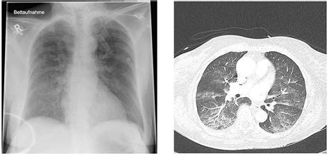 Pulmonary Edema Chest X Ray