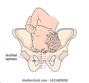 Ischial Spine Palpation