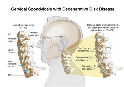 Cervical Disc Disorder