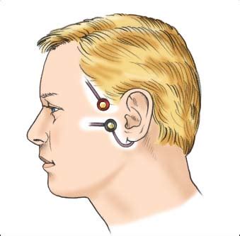 Peripheral Nerve Stimulation | Nurse Key