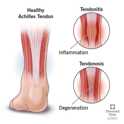 Tendinopathy: What It Is, Symptoms, Causes & Treatment