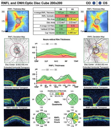 Elevated-Tension Open-Angle Glaucoma; Moderate Damage - Decision-Maker PLUS