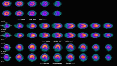 Nuclear Medicine Scan Heart