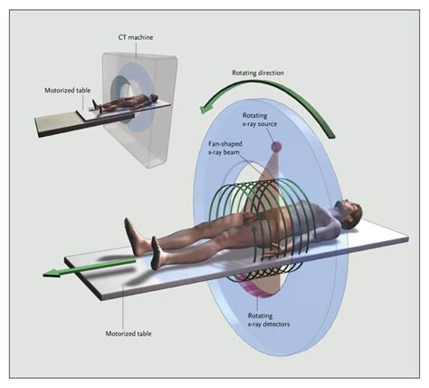 Computed Tomography — An Increasing Source of Radiation Exposure | NEJM