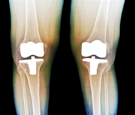 Bilateral Total Knee Replacement Photograph by Zephyr/science Photo ...