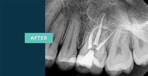 Root Canal - Before & Afters | Midtown Endodontist NYC