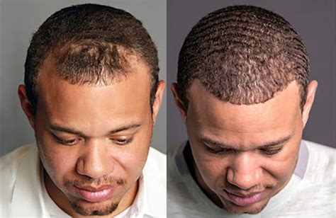 Hair Transplant Before/After Results for Men - Bosley Hair Transplant