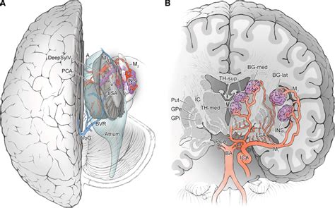 Deep Arteriovenous Malformations in the Basal Ganglia, Thalamus, and ...